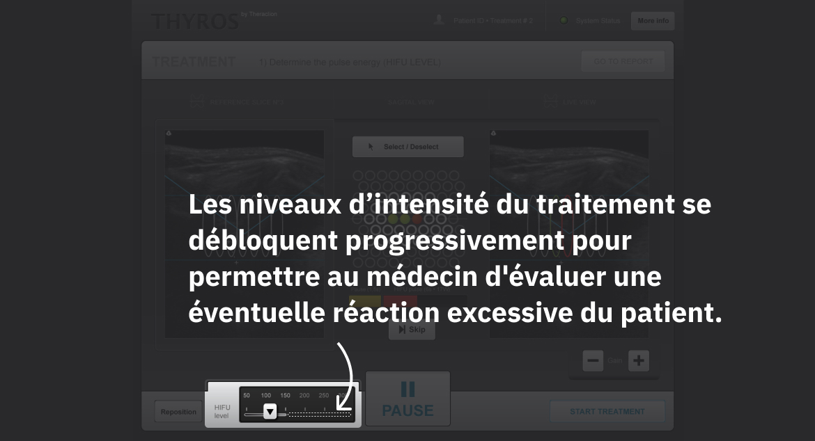 Les niveaux d'intensité du traitement se débloquent progressivement pour permettre au médecin d'évaluer une éventuelle réaction excessive du patient.