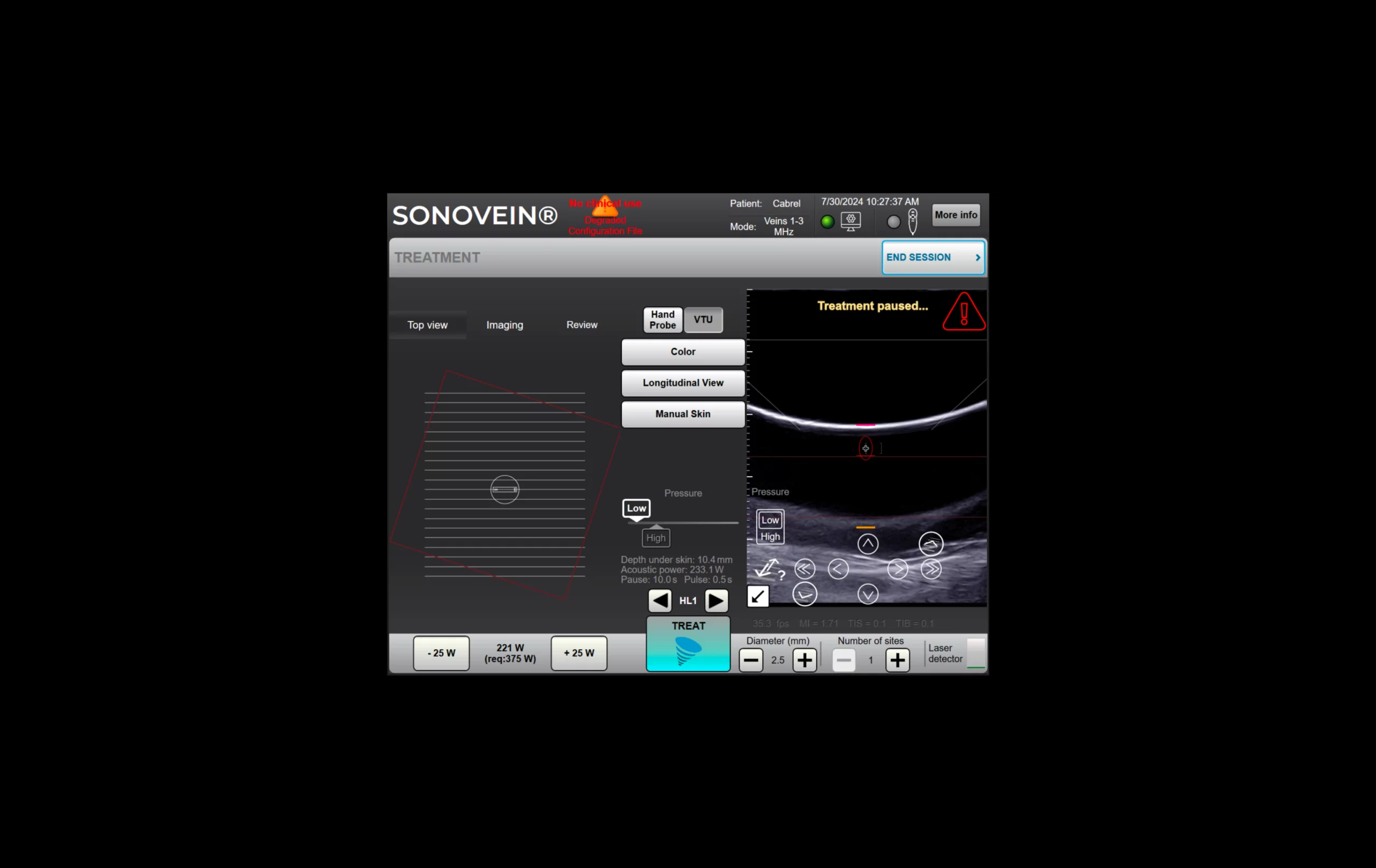 Pr_Theraclion_Sonovein_before_2x
